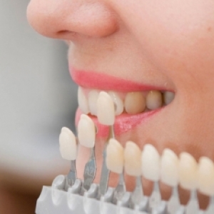 Lentes de contato dental: tudo o que você precisa saber sobre essa técnica