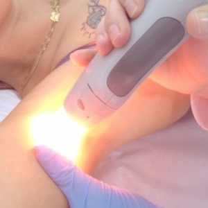 Conhecida rede de depilação a laser faz ação promocional com descontos para clientes