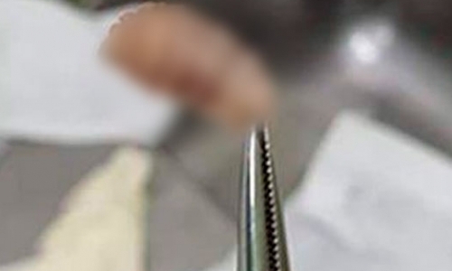 Mais de 50 larvas são retiradas de boca de idosa vítima de maus tratos