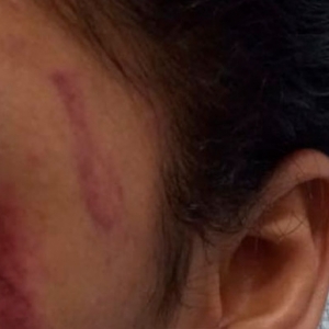 Enteada fica com rosto cheio de lesões após ser agredida por padrasto