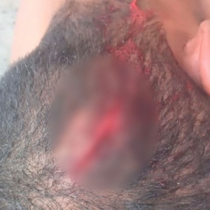 Briga entre moradores de rua termina com um deles precisando levar pontos na cabeça