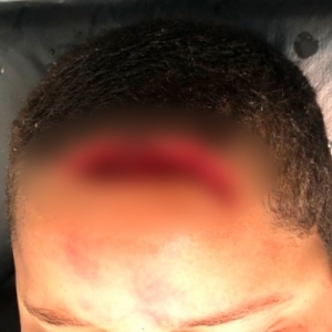 Acidente em cemitério provoca corte profundo na cabeça de criança