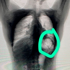 Traficante engole pedras de crack para fugir de flagrante