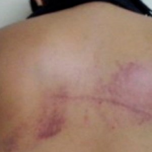 Autor de agressões obriga vítima a dizer para a polícia que caiu de bicicleta