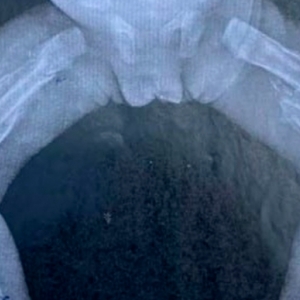 Bebê de apenas dez meses dá entrada em hospital após ser torturada e sofrer diversas fraturas