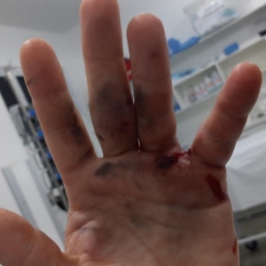 Morador de São João Batista acerta a própria mão com pistola