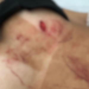 Jovem transexual tem garfo cravado no peito após discussão com amiga