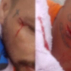 Funcionário da coleta de lixo sofre ferimento grave no pescoço devido a pedaços de vidro em saco de lixo