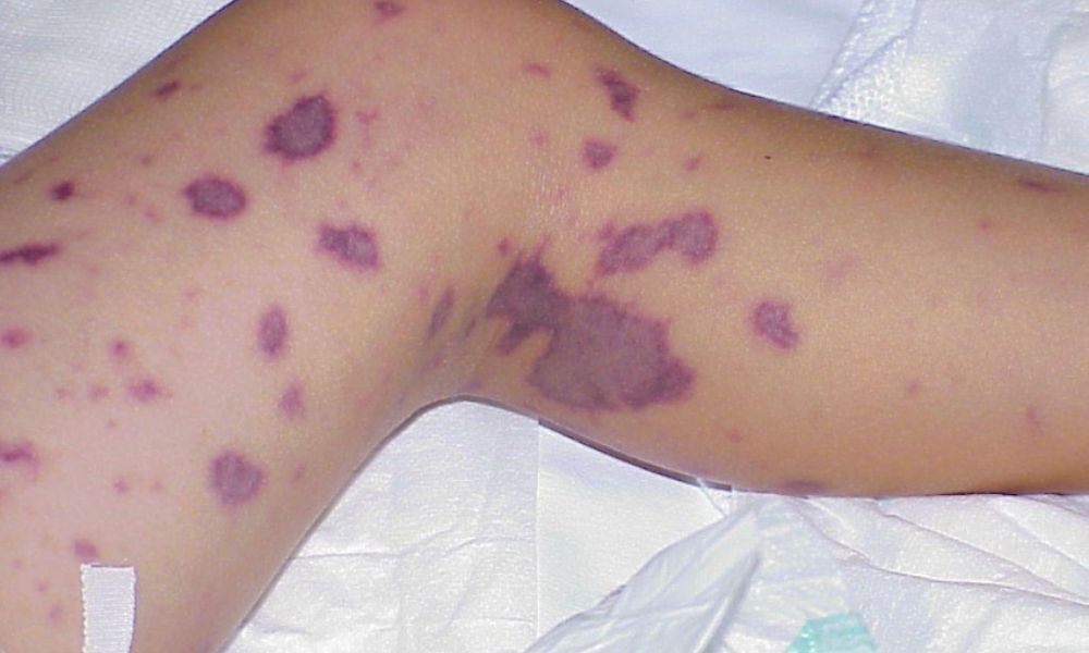 Três casos de meningite viral confirmados em Tijucas; Outros dois sob investigação