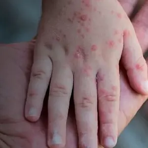Todos os contatos de caso de Monkeypox testam negativo em Itapema