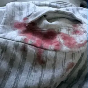 Jovem de 22 anos é ferido no rosto por linha com cerol enquanto voltava do trabalho