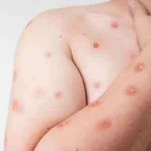 Mpox: Casos suspeitos de mpox acendem sinal de atenção em Santa Catarina