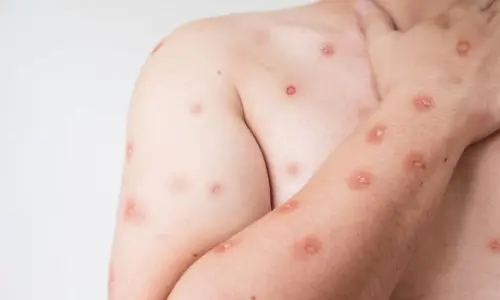 ALERTA | Casos suspeitos da doença na região acendem sinal de atenção 