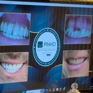  MINUTO ODONTO | Implante dentário não é exclusivo para idoso
