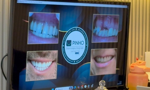  MINUTO ODONTO | Implante dentário não é exclusivo para idoso