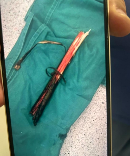 Homem tem pulmão perfurado por galho durante encontro de trilheiros