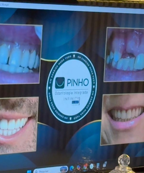 MINUTO ODONTO | Implante dentário não é exclusivo para idoso